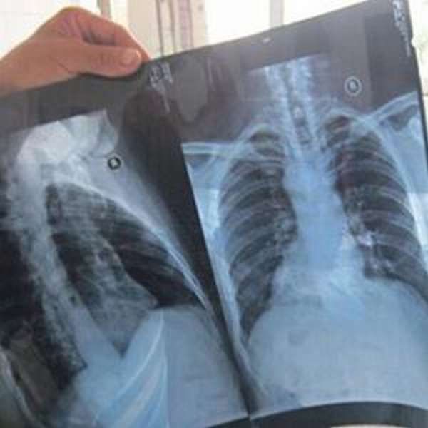 Приревновала любимого и сломала сопернице ребра