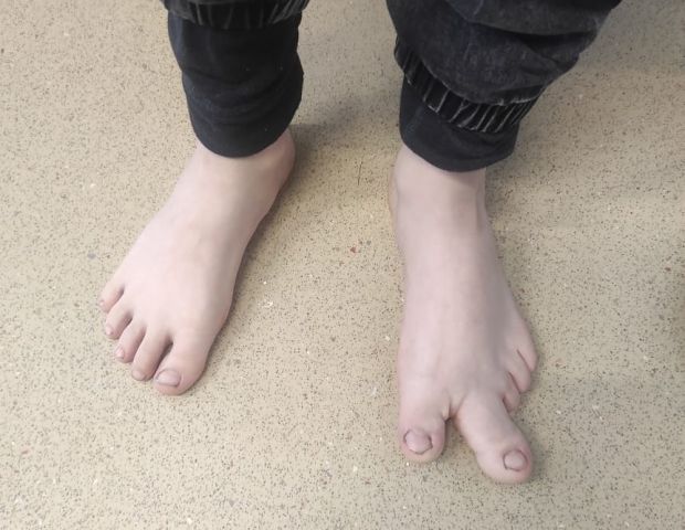 Новосибирские врачи помогли мальчику с гигантским пальцем