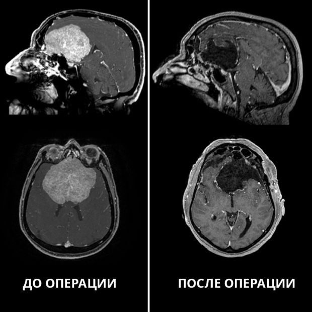 68-летнему кемеровчанину удалили опухоль мозга в Центре Мешалкина