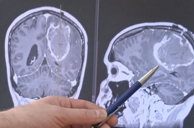 Женщину с самой опасной опухолью мозга прооперировали в Центре Мешалкина